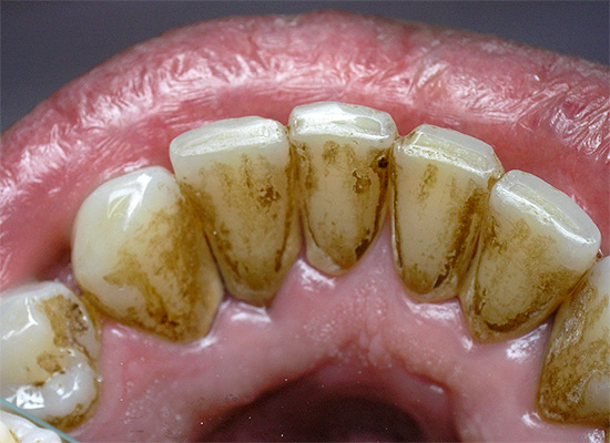 Tartrul se acumulează adesea pe suprafața interioară a dinților frontali inferiori.