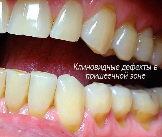 Παρουσιάζοντας σφηνοειδή ελαττώματα, η χρήση μιας λεύκανσης οδοντόκρεμας με υψηλή τριβή θα επιδεινώσει μόνο την κατάσταση ...
