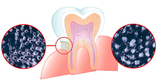 L'image montre schématiquement comment le strontium, le calcium et les sels de fluor peuvent réduire la sensibilité dentaire en obstruant les tubules dentinaires.