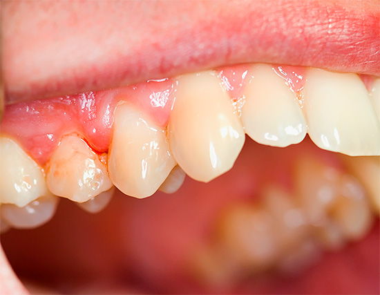 Les dentifrices Mexidol dent sont principalement axés sur le traitement et la prévention des maladies des gencives (parodontite, maladie parodontale, gingivite, etc.)