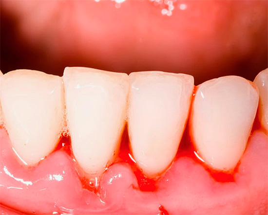 Pomorinske paste za zube posebno su popularne kao sredstvo u borbi protiv upale desni i krvarenja.