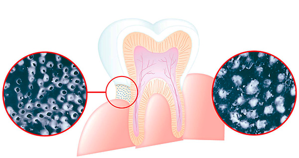 Bilden visar hur strontiumacetat bidrar till att minska tandkänsligheten.
