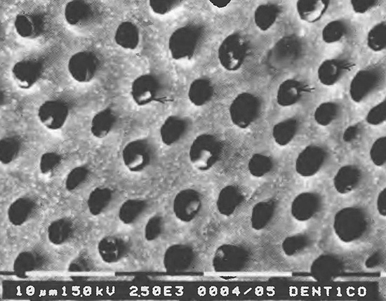 Fotografia de dentina a microscopi electrònic: les boques dels túbuls dentinals són visibles.
