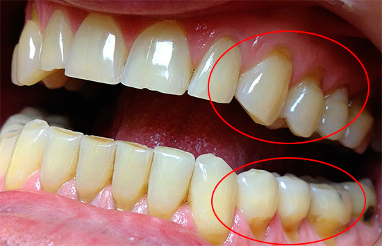 La foto mostra defectes en forma de falca a la zona cervical, sovint provoquen una major sensibilitat de les dents.