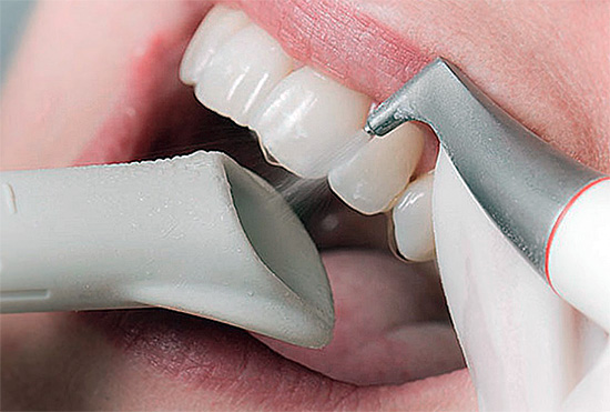 Et ici, le processus de blanchiment (éclaircissement) des dents par la technologie Air Flow est déjà montré.