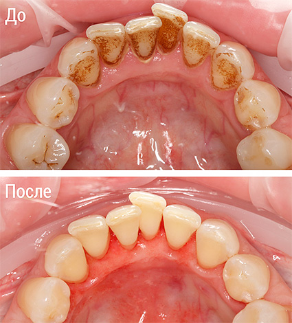 La foto muestra la apariencia de los dientes antes y después del procedimiento Air Flow.