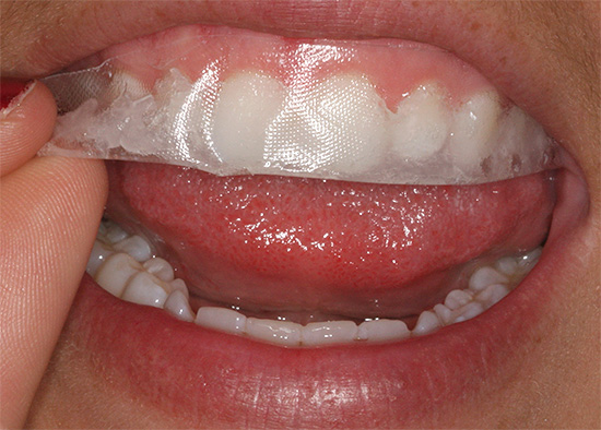 แถบฟอกสีฟันถูกนำไปใช้กับฟันในบริเวณรอยยิ้ม