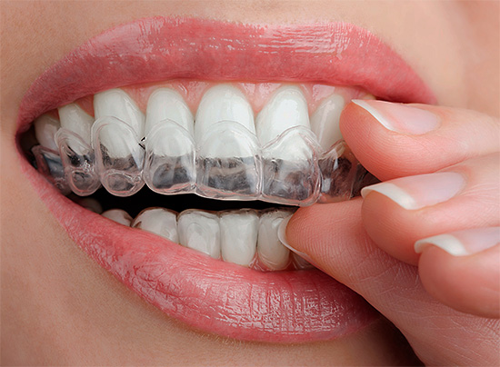 Para blanquear el esmalte dental en casa, también se utilizan protectores bucales con un gel especial.