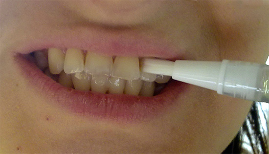 An example of applying gel from a whitening pencil to teeth.
