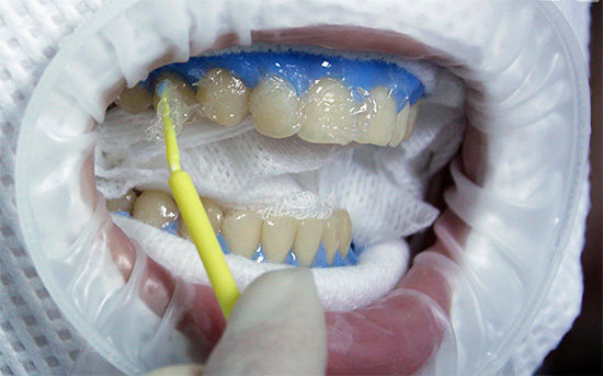 Sann tandblekning involverar kemisk förstörelse av färgade föreningar som utgör strukturen i ytskiktet av emalj.