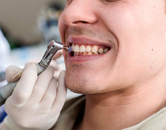 Lebih tepat untuk memanggil pemutihan gigi mekanikal pencerah - dalam kes ini hanya deposit berwarna dari permukaan enamel dikeluarkan.