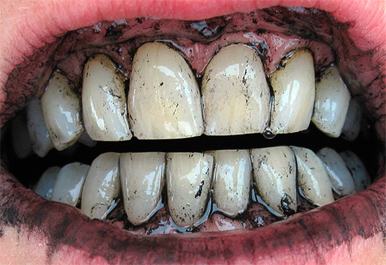 Eine alte Volksmethode der Zahnaufhellung besteht darin, sie mit Holzkohle zu reinigen ...