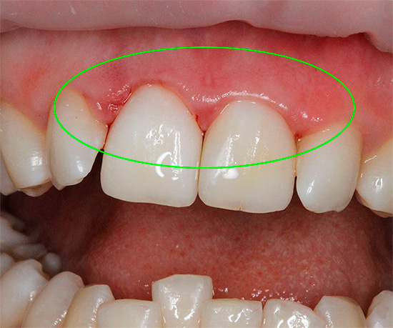 Attempts to whiten teeth at home are far from safe and often lead to serious burns to the gums.