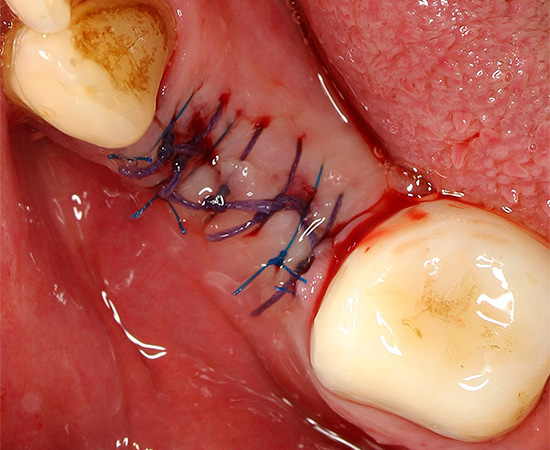 Sometimes, after tooth extraction, sutures are applied to the wound.