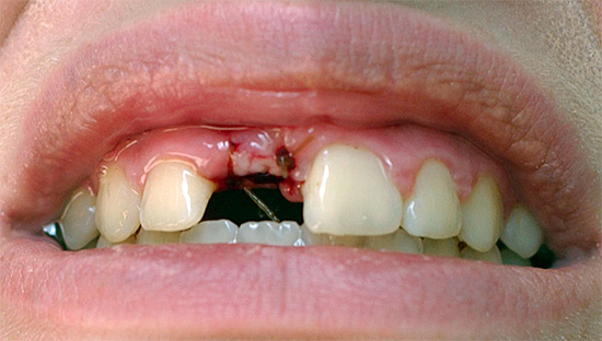 Bylinné léčiva se někdy používají k výplachu úst po extrakci zubu - bylinné přípravky jsou důležité - je pouze důležité je správně vybrat.