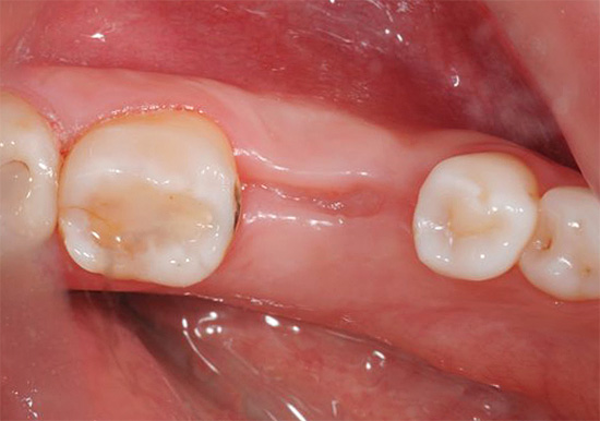 La foto mostra un exemple d’una geniva curativa amb èxit (3 mesos després de l’extracció de dents).