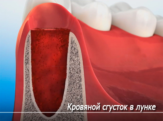 Zdjęcie schematycznie pokazuje skrzep krwi w zębodole (otworze zęba).