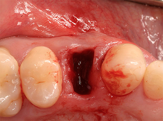 Jednou z funkcí propláchnutí úst je odstranění částeček potravin z otvoru pro zuby a snížení počtu bakterií v něm.