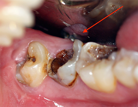 Manchmal sind die Zähne neben dem zu entfernenden Zahn stark von Karies betroffen, was das Risiko einer weiteren Entzündung der Zahnpfanne erhöht.