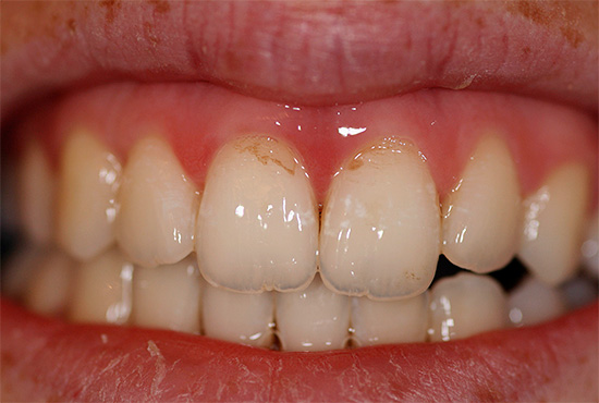 Le paste sbiancanti rimuovono i depositi pigmentati dalla superficie dello smalto - a causa di ciò, i denti diventano visivamente più leggeri.