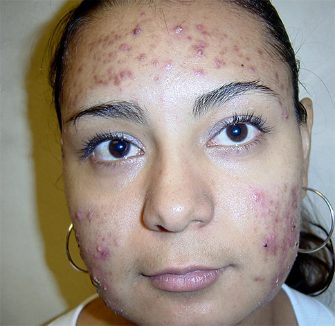 Akne im Gesicht tritt normalerweise aufgrund der übermäßigen Vermehrung von Mikroorganismen auf, beispielsweise in den Talgdrüsen.