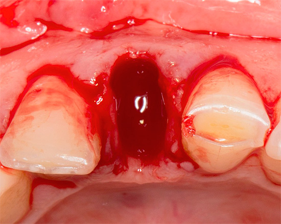 Dans les premiers jours après l'extraction dentaire, les rinçages buccaux intensifs sont inacceptables, car ils créent un risque de lessivage d'un caillot sanguin du trou.