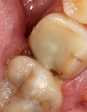Voit huuhdella suuasi lievittääksesi hammassärkyä myös vakavissa hammasongelmissa - syvissä kario-onteloissa, pulpiitissa, parodontiitissa jne.