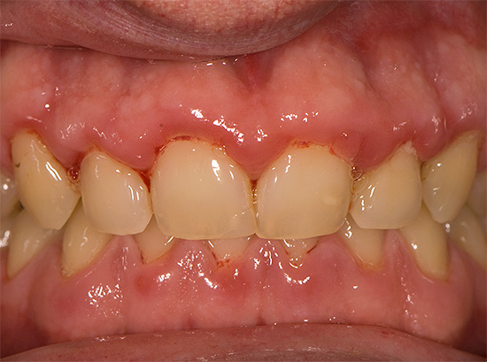 Oft denkt ein Mensch nur, dass seine Zähne weh tun, aber tatsächlich tut sein Zahnfleisch weh ...