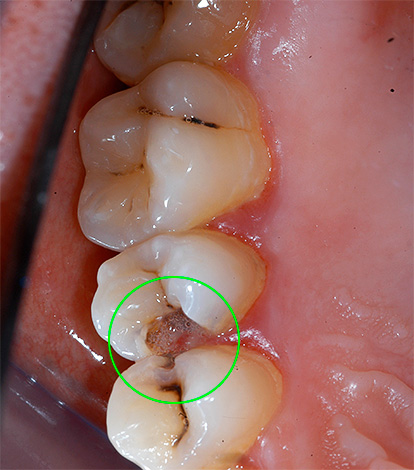 Prin clătirea gurii, puteți elimina eficient iritanții (resturile alimentare) din cavitatea profundă.