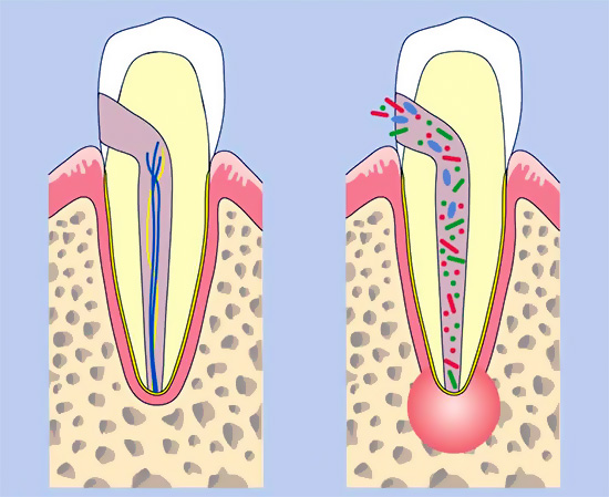 Dengan pulpitis atau periodontitis, bilas panas menggalakkan aliran keluar nanah dari tapak keradangan.