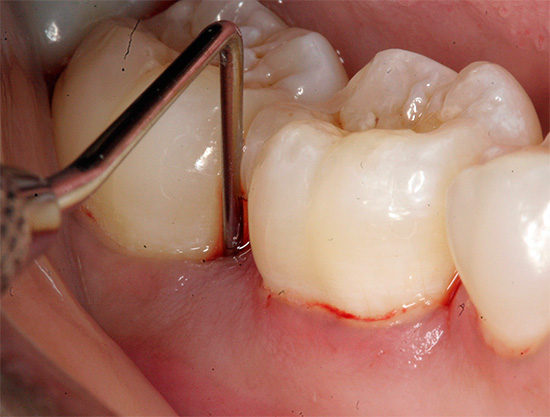 In the so-called gingival pocket, plenty of food debris and bacteria accumulate in abundance ...