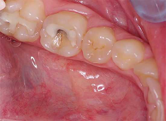 Kartais stiprus skausmas atsiranda dantyje, kuriame yra senas ar net šviežias plombavimas.