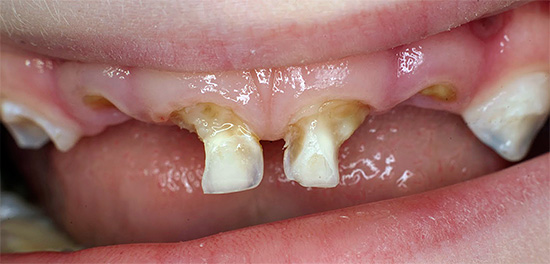 Na fotografii sú zobrazené detské zuby zničené zubným kazom.