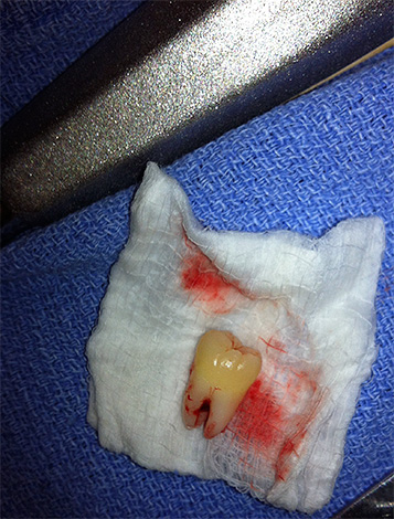 Après l'extraction des dents, les chirurgiens prescrivent généralement des analgésiques.