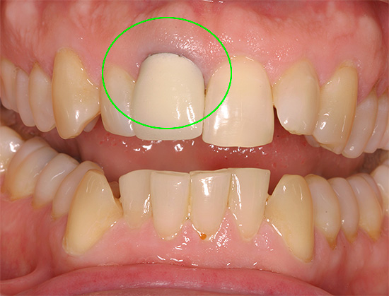 Понекад круница постављена на зуб постаје узрок боли.