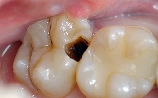 Czasami można pozbyć się bólu zęba w domu za pomocą wacika zwilżonego na przykład roztworem lidokainy i zatopionego w próchnicy.