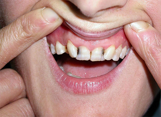 Zvyk neustále potlačovat bolesti zubů s prášky obvykle nevede k ničemu dobrému ...