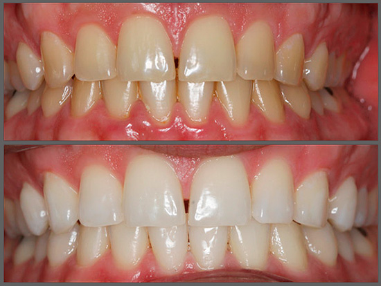 Αυτός είναι ο τρόπος εμφάνισης των δοντιών πριν και μετά την φωτοευαισθητοποίηση.