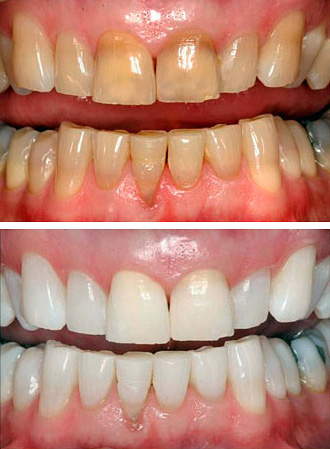 Een foto van tanden voor en na het bleken van foto's met de zoommethode.