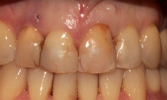 Εάν υπάρχουν γεμίσεις στα μπροστινά δόντια, τότε μετά τη διαδικασία φωτοευαισθητοποίησης μπορεί να φαίνονται πιο σκούρα από το περιβάλλον σμάλτο.