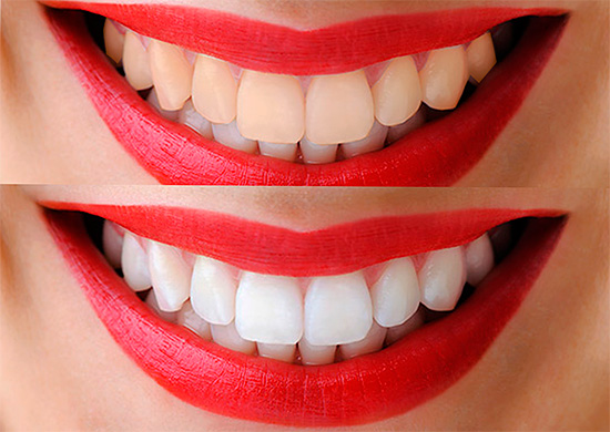 With photobleaching of teeth, it is really possible to lighten enamel for 12 and even more tones in a short time.