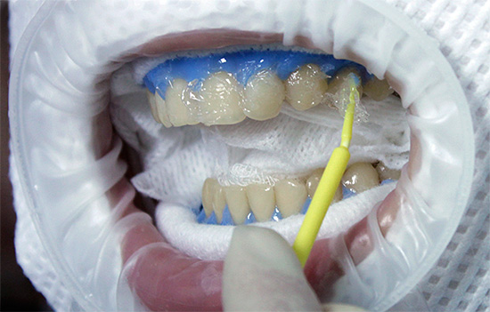 Zdjęcie pokazuje nałożenie żelu wybielającego na powierzchnię przednich zębów.