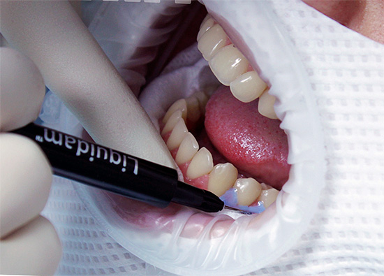 The photo shows the application of liquid rubber dam on the gums.