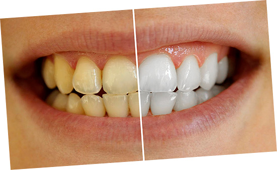 Est-il vraiment possible à la maison de blanchir efficacement ses dents sans nuire à l'émail? Essayons de le comprendre ensemble ...
