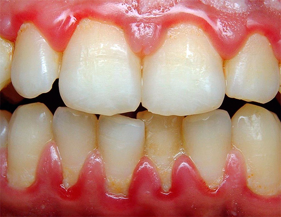 Beyazlatma şeritleri kullanıldığında, diş etlerinde kimyasal yanma riski vardır.