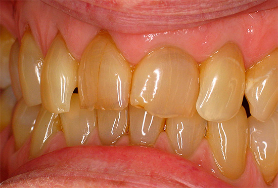 La causa de la coloración amarillenta del esmalte dental puede ser, por ejemplo, fumar, así como el uso regular de café y té fuertes.