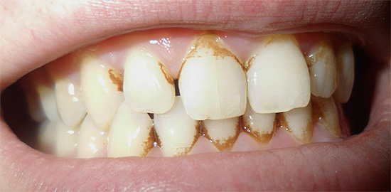 Jeśli zauważysz obfite złogi zębów na szkliwie, lepiej przejść profesjonalną procedurę higieny jamy ustnej.