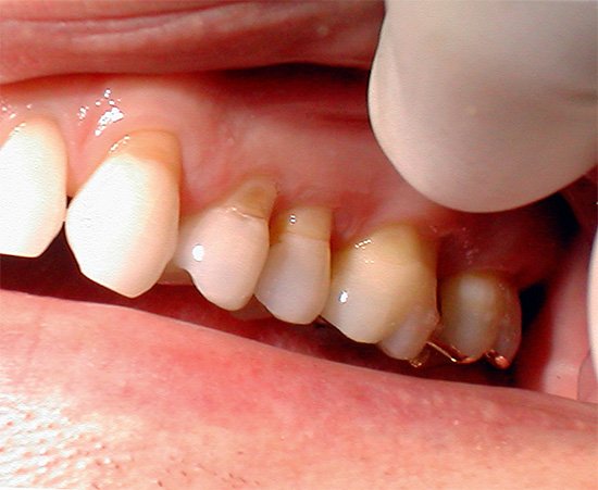 La foto mostra difetti a forma di cuneo: depressioni nella regione cervicale dei denti.
