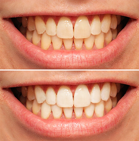 Na fotografii je znázornený príklad toho, ako môžu zuby vyzerať pred a po fotobielení.