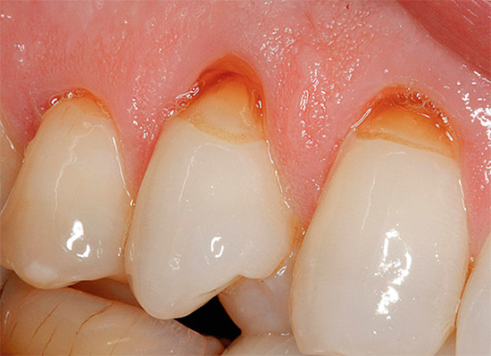 L'utilisation de dentifrices hautement abrasifs peut entraîner un approfondissement des défauts en forme de coin.